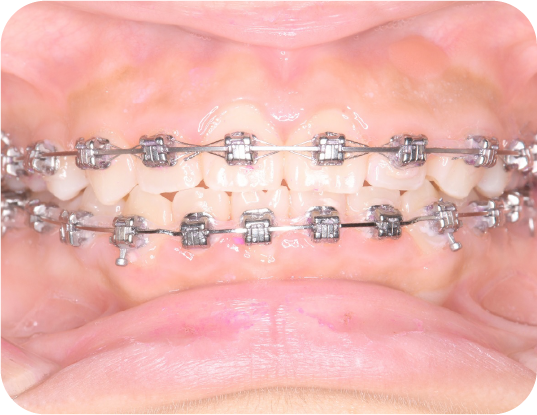 セルフライゲーションブラケット装置（デーモンシステム）