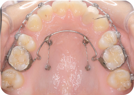 歯科矯正用アンカースクリュー（デュアル・トップオートスクリュー）